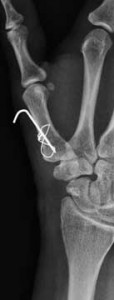 1 First metacarpal osteotomy with fixation.