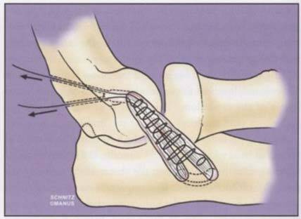 Lateral Collateral Ligament Reconstruction