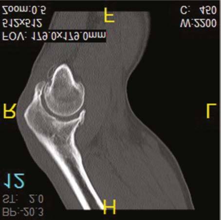 CT Scan of Bone Spurs in the Front and Back of the Elbow. The Arrows Point to the Bone Spurs