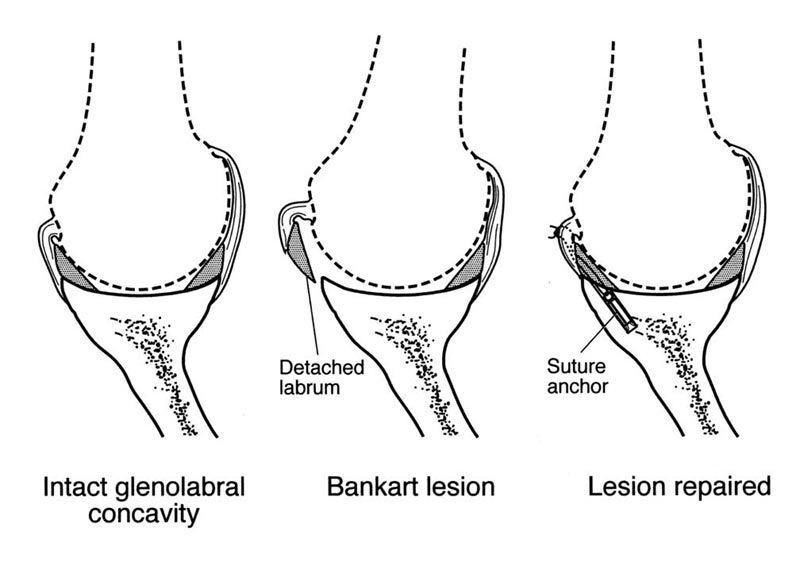 shouldersurgery1