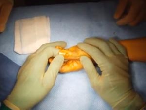 View video of Mucous Cyst Excision Surgery